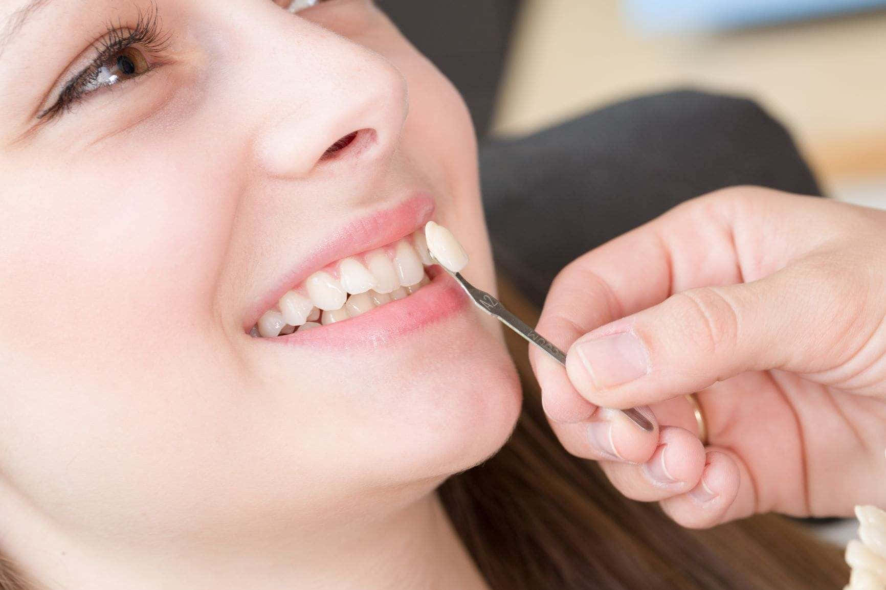 Teeth Whitening 桌布 壁紙 — 一位微笑女性的特寫，牙科專業人員用鑷子貼上牙色貼片。