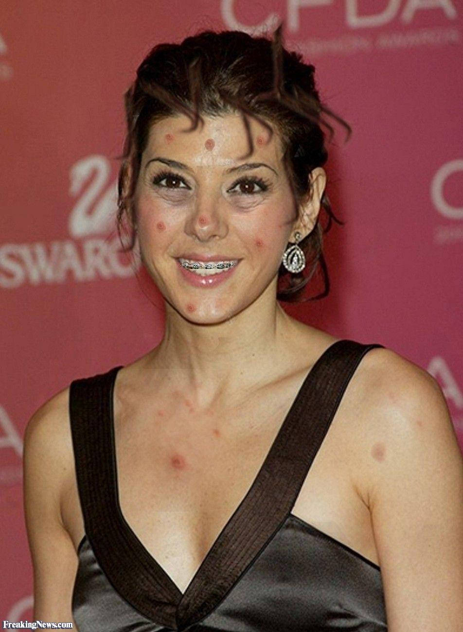Celebrity 桌布 壁紙 — 一位戴牙套且有明顯痘痘印的女性，穿著深色緞面連衣裙在紅毯活動上微笑。