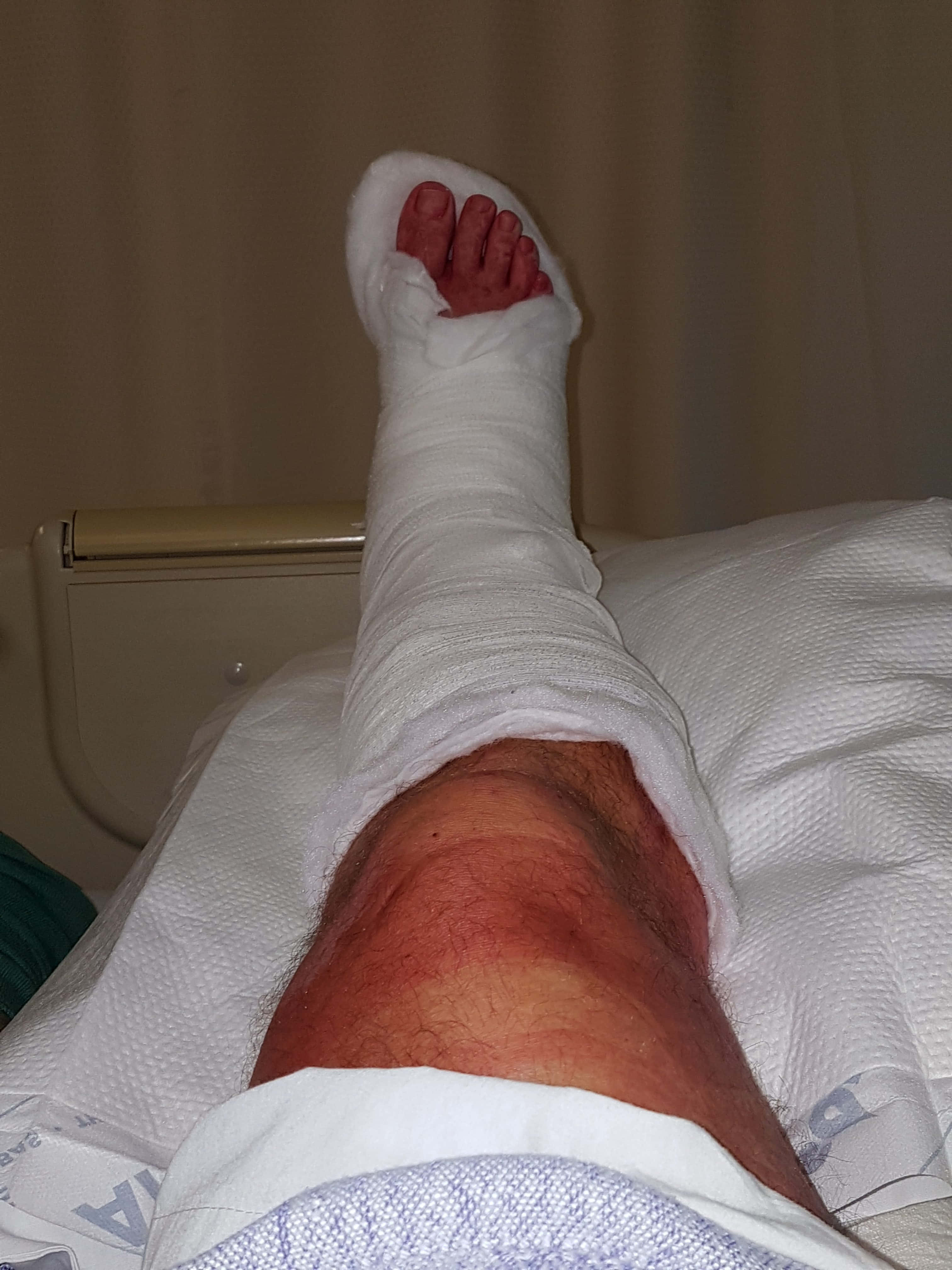feet 桌布 壁紙 — 一個人腿部的特寫，從腳到小腿中部包著白色石膏，放在醫院床上，石膏下方有明顯的紅色皮膚刺激。
