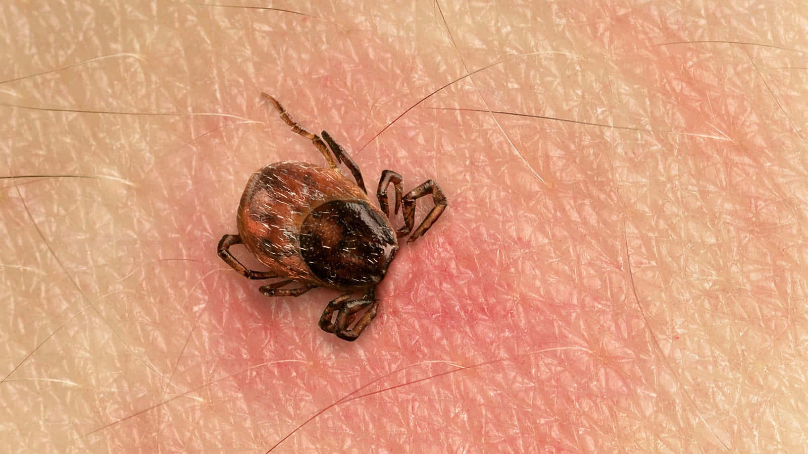 skin 桌布 壁紙 — 一張深棕色蜱蟲嵌入人體皮膚的特寫照片，可見紅色刺激和細毛。