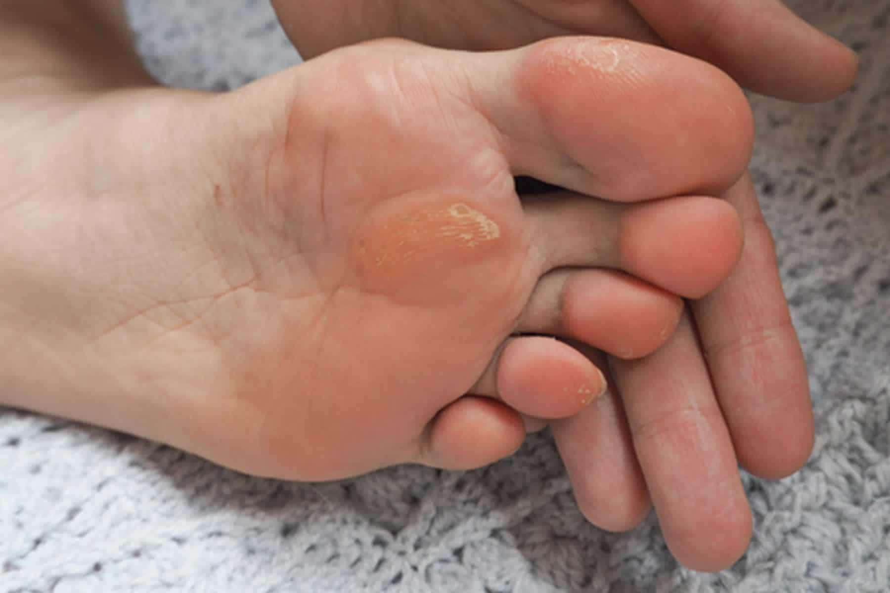 feet 桌布 壁紙 — 一隻手在有紋理的灰色毯子上輕輕托住一隻皮膚脫落的腳的特寫。