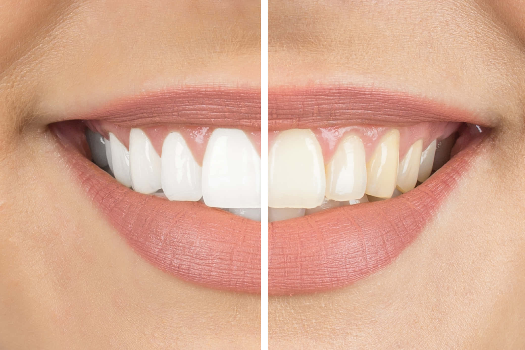 Teeth Whitening 桌布 壁紙 — 人物微笑的分割畫面近鏡，顯示牙齒美白治療前後對比。
