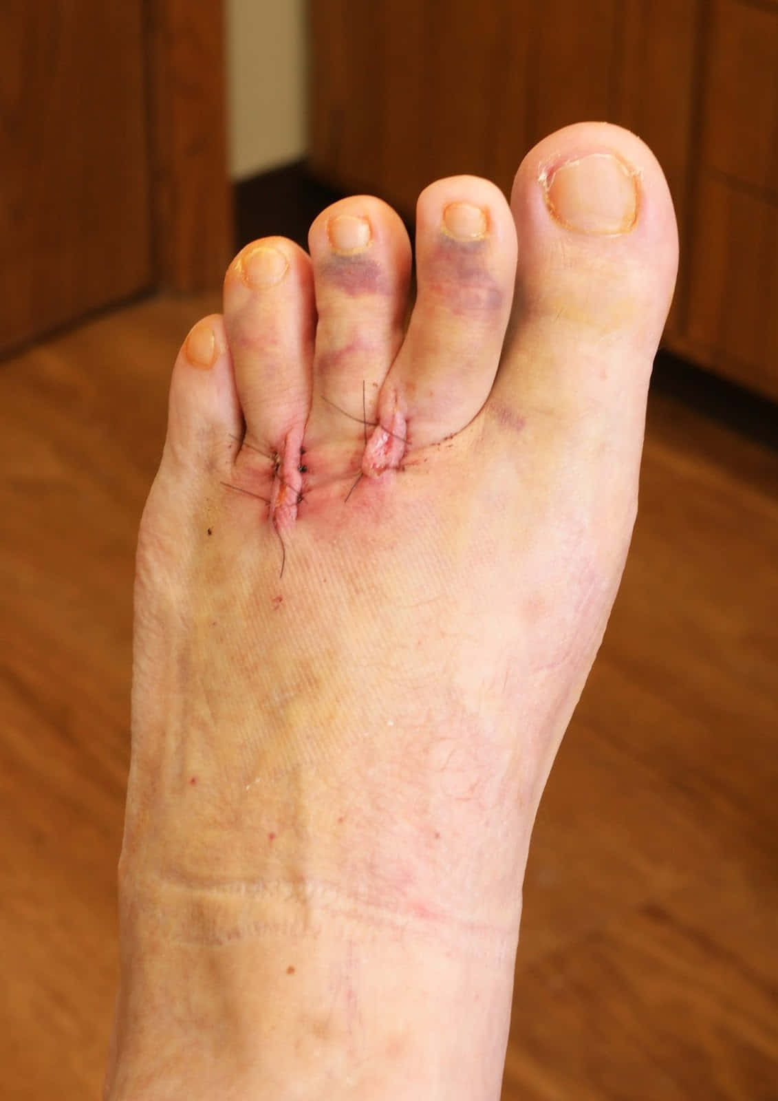 feet 桌布 壁紙 — 人類腳部特寫，腳掌有可見縫合線和瘀傷，背景為木地板。