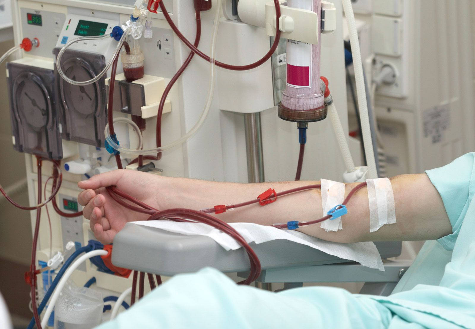 Hospital 桌布 壁紙 — 在臨床環境中進行血液治療期間，病人的手臂通過管道和夾子連接到血液透析機。