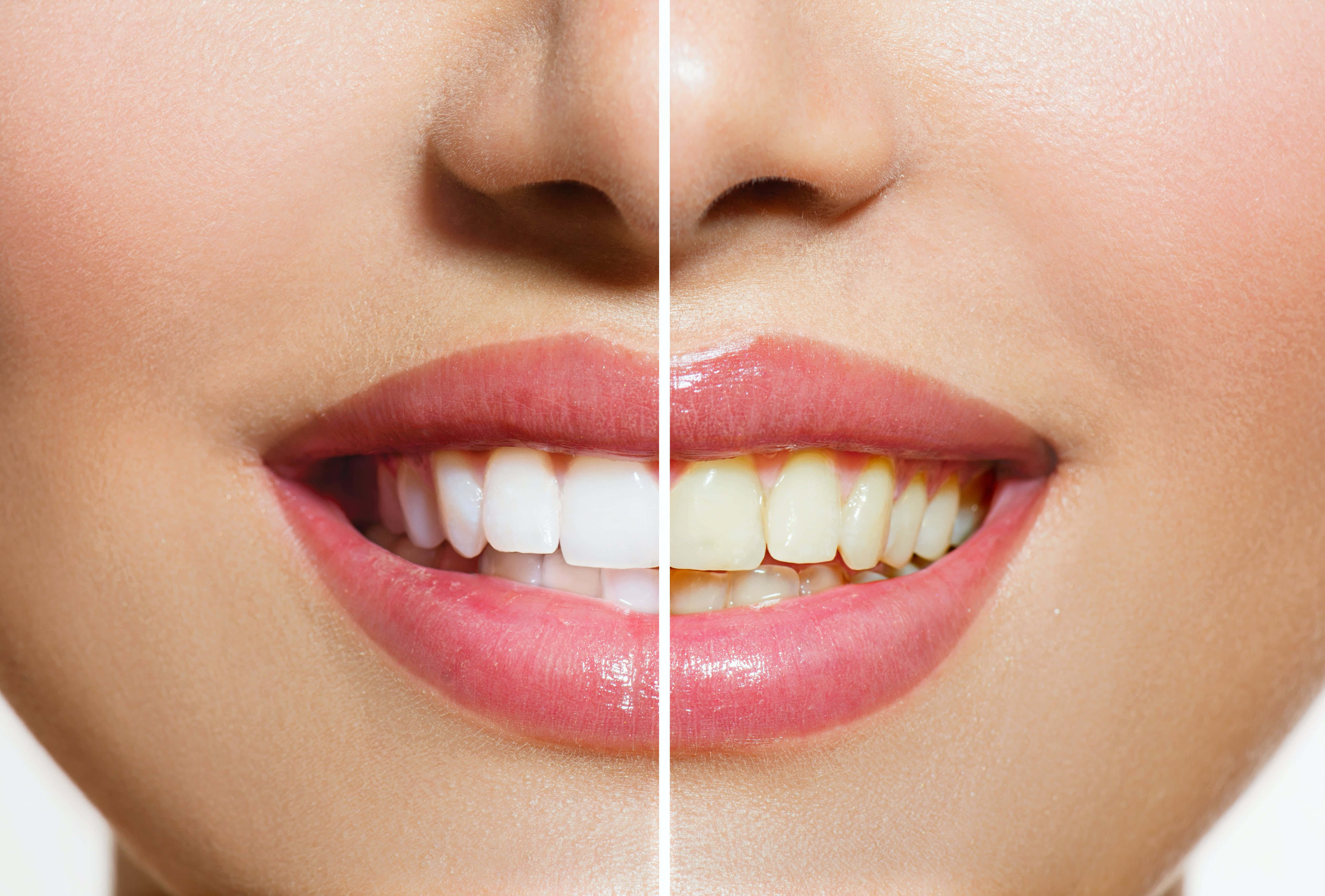 Teeth Whitening 桌布 壁紙 — 女性微笑的分割視圖，顯示亮白牙齒與發黃牙齒之間的鮮明對比。