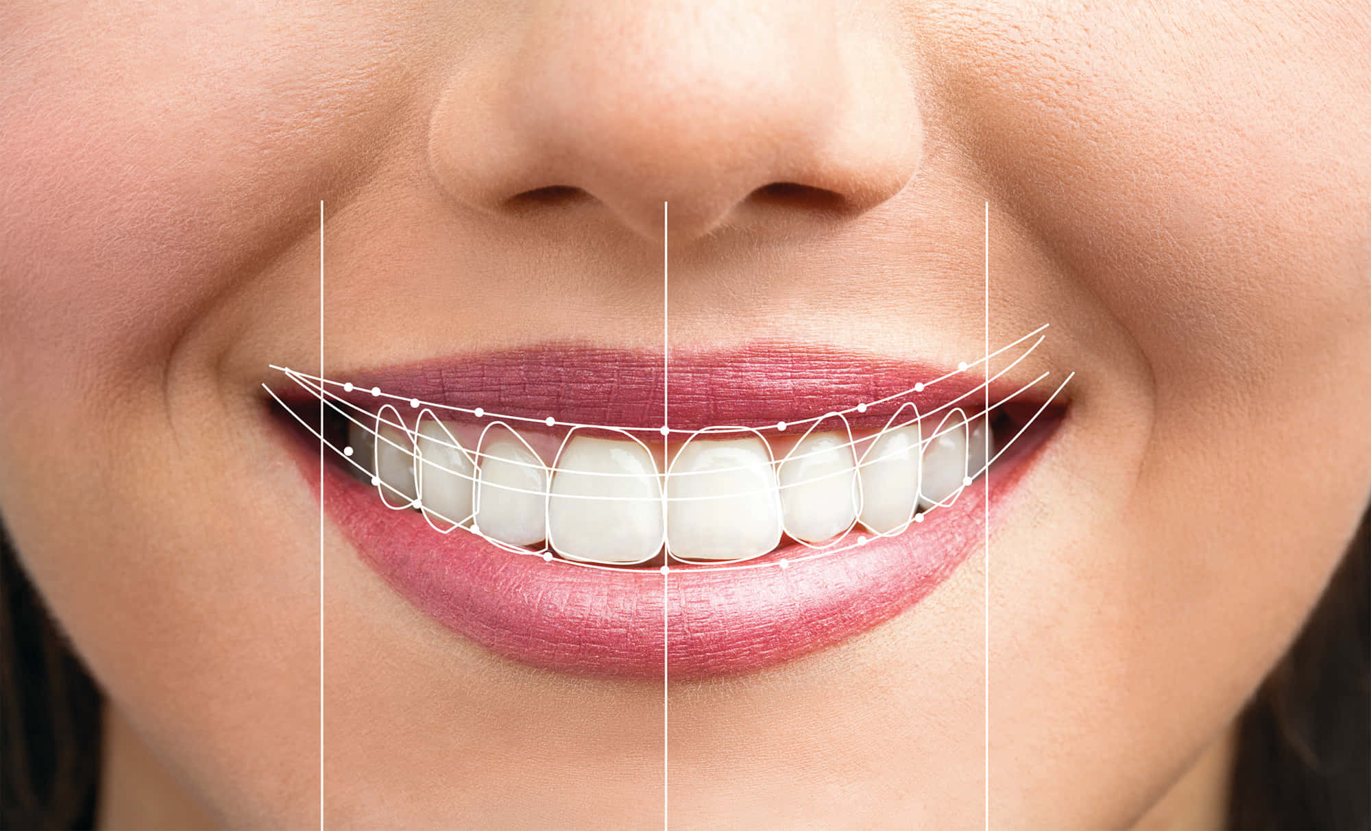 Smile 桌布 壁紙 — 微笑的人嘴巴的特寫，牙齒矯正線疊加在完美整齊的牙齒上。