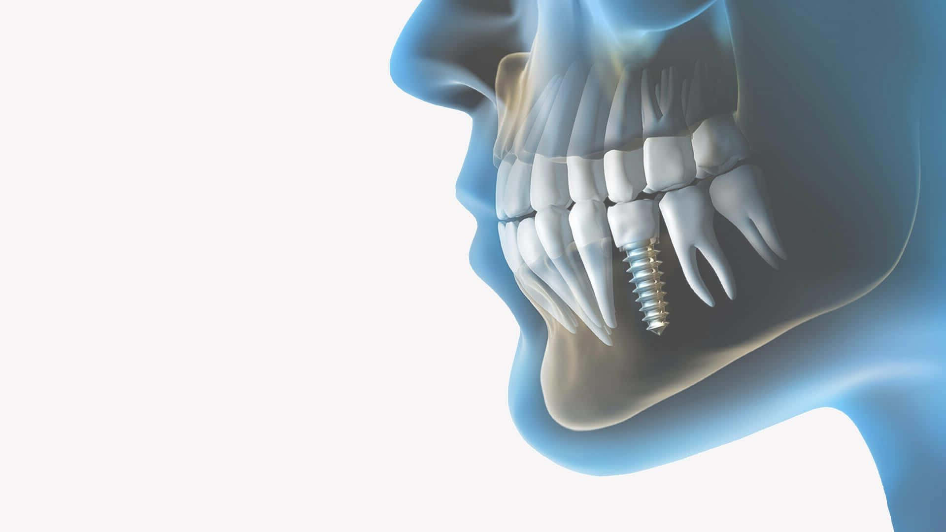 Tooth 桌布 壁紙 — 詳細的3D渲染人類下顎，牙齦線下可見牙科植體螺絲。