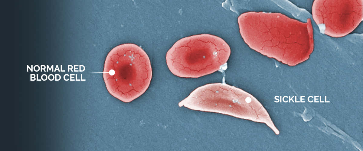 Red Blood Cells 桌布 壁紙 — 顯微鏡視圖，比較正常紅血球與鐮狀細胞，背景為藍色紋理。