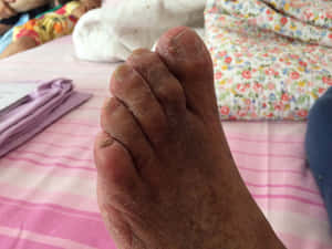 一位長者乾裂的腳部在粉紅色條紋床單上。 — 指甲 壁紙